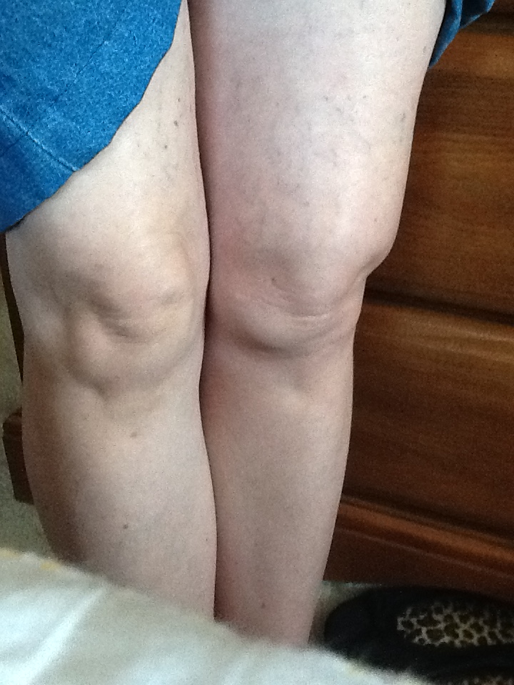 Photo of swollen and bruised legs.