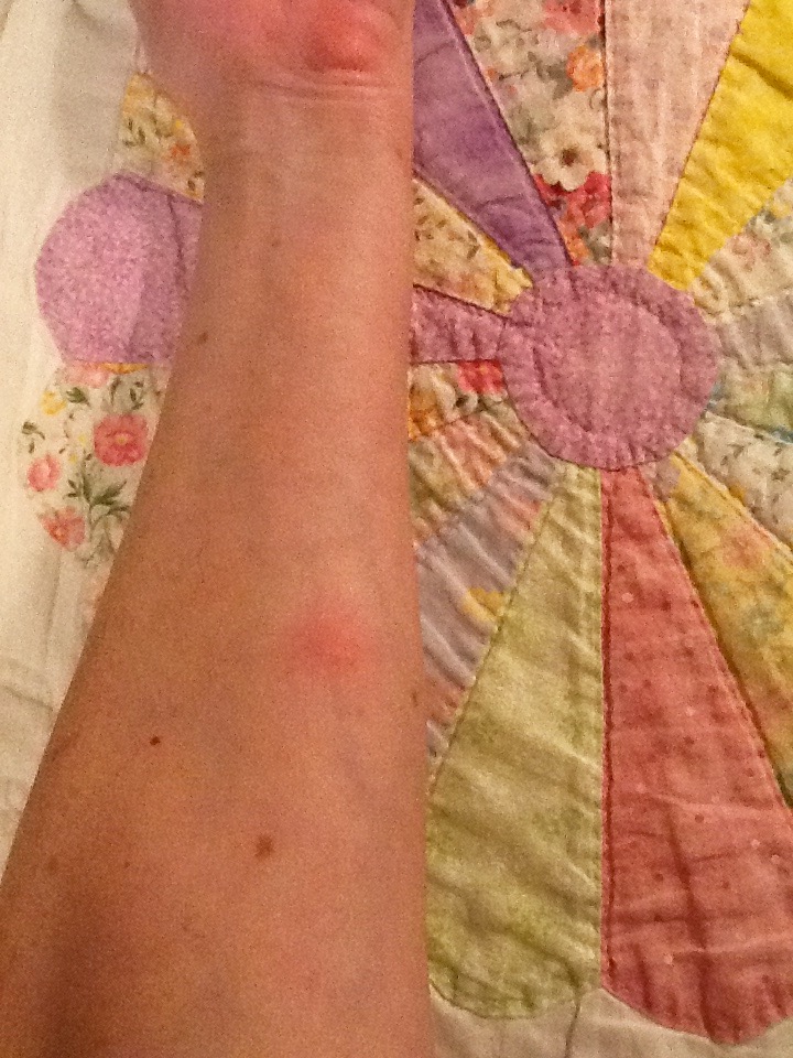 I got stung by a bee while working in the garden.