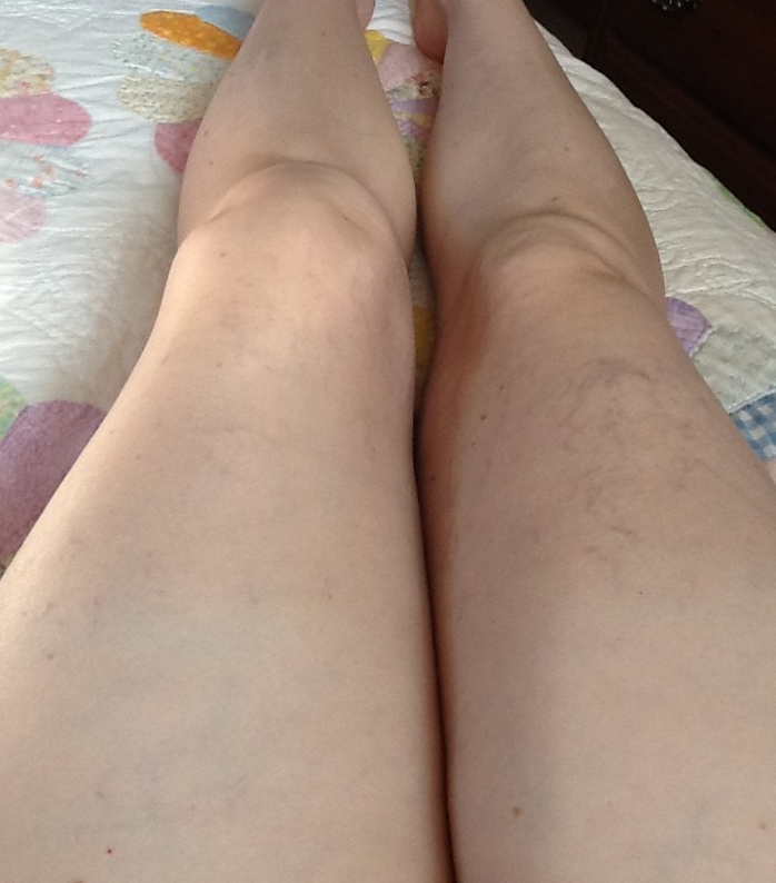 Fat, swollen, bruised legs.